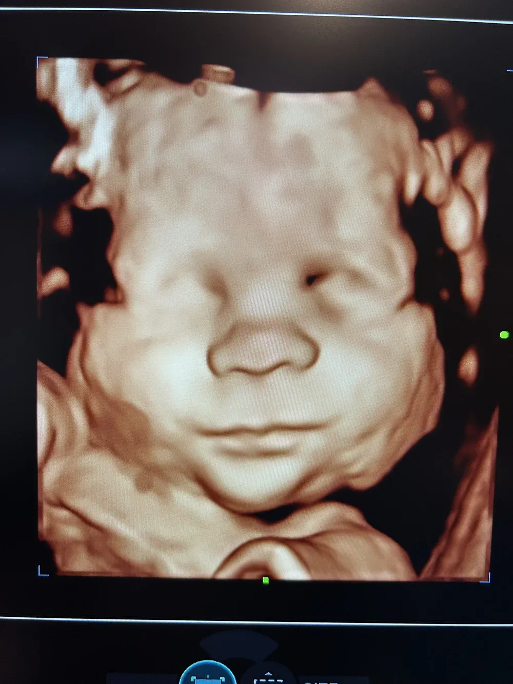 3D/4D ultrasound of a baby's face, front view